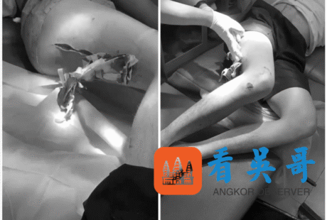 被砍4刀逃出西港园区之后：同伴被卖妙瓦底KK园区